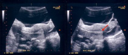 Síntomas transferencia embrionaria